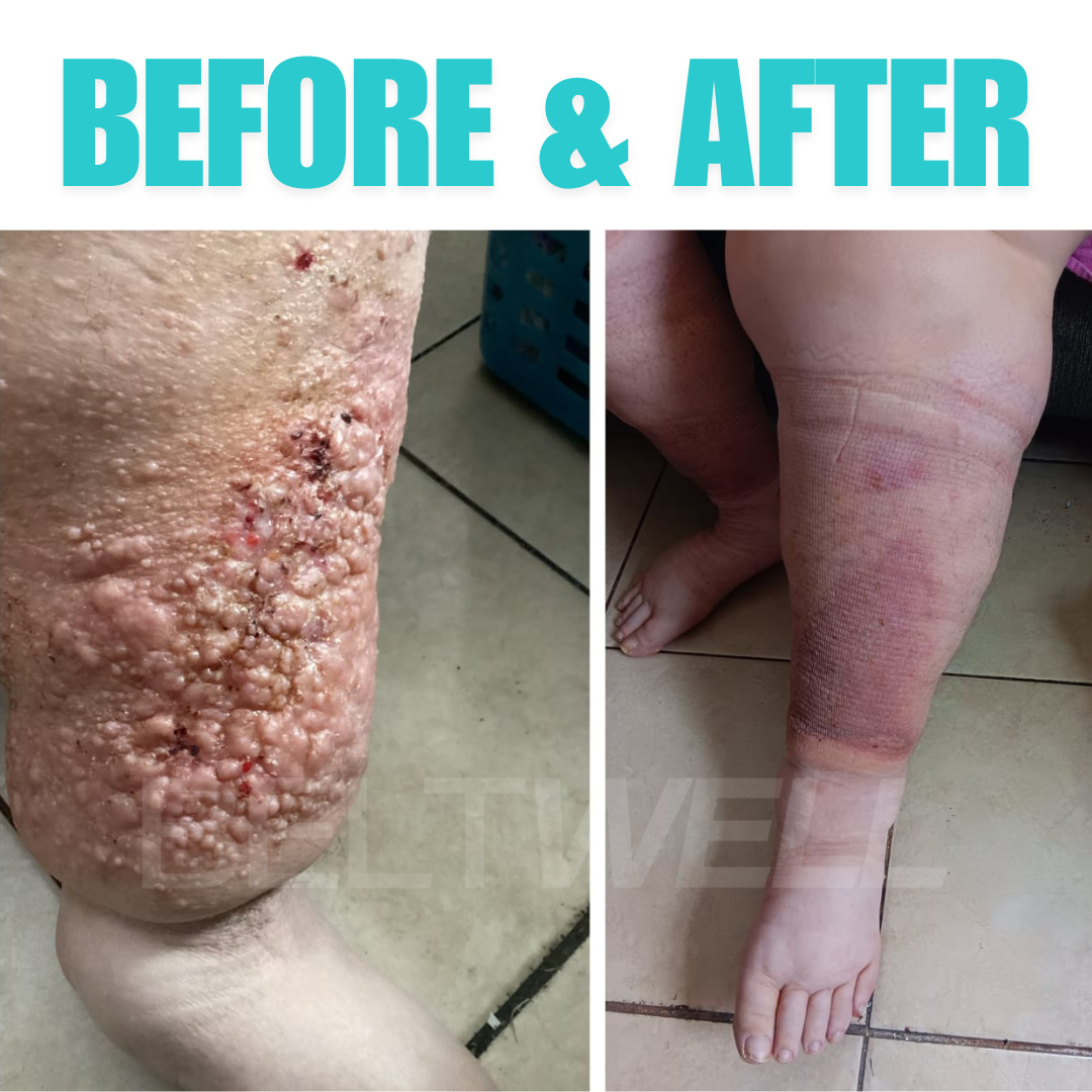 Beltwell® The Full Leg Compression Bundle (Foot, Calf, Thigh) + 8 FREE Bonuses | BEIGE