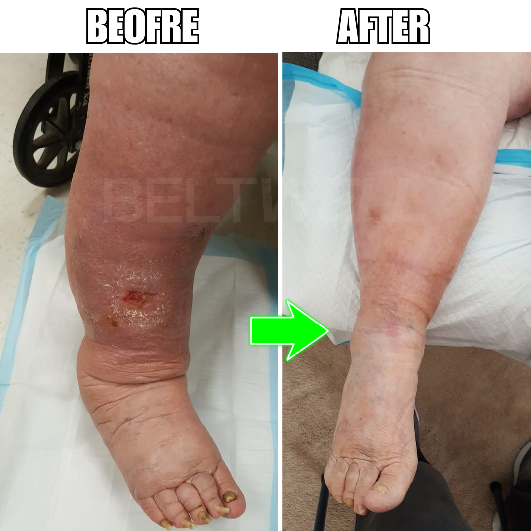 Beltwell® Calf Compression Wrap